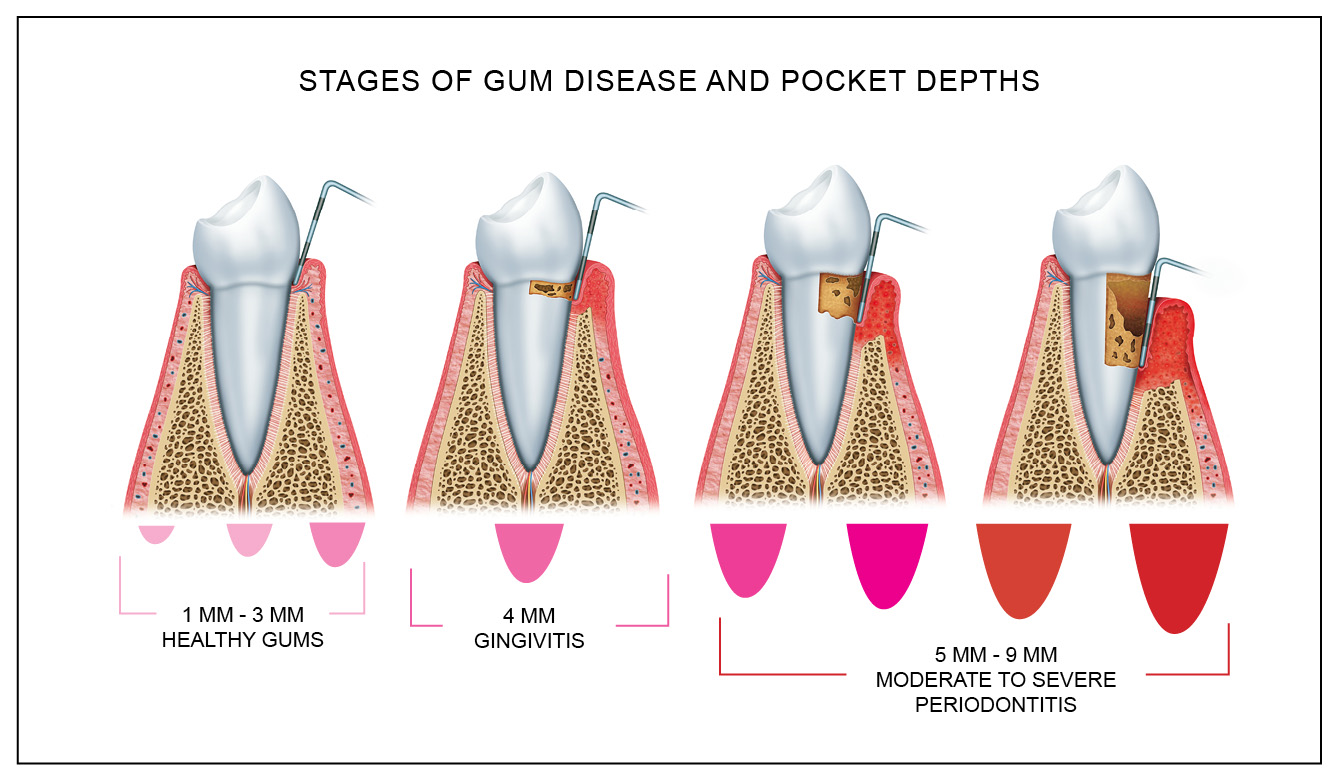 periodontal gum disease